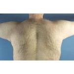 Gynecomastia Before & After Patient #420