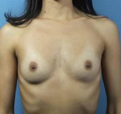 Breast Augmentation Before & After Patient #68