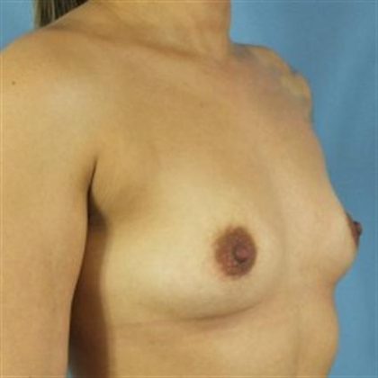Breast Augmentation Before & After Patient #125