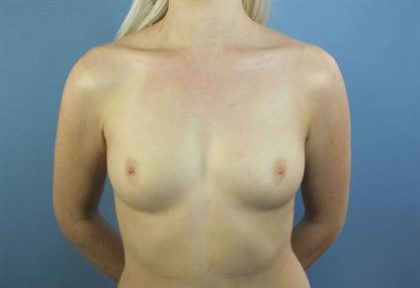 Breast Augmentation Before & After Patient #140