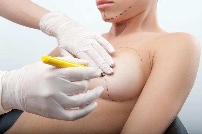 Breast Revision Fairfield