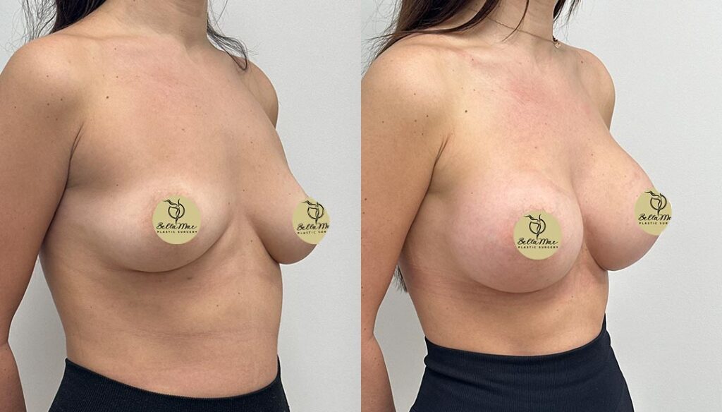 Breast Augmentation White Plains 02