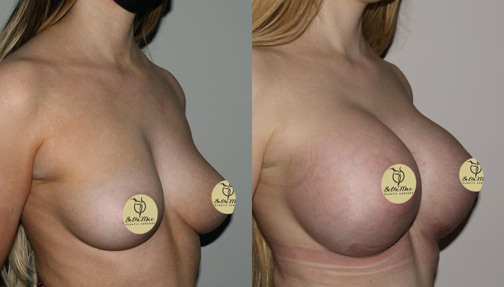 Breast Augmentation White Plains 03