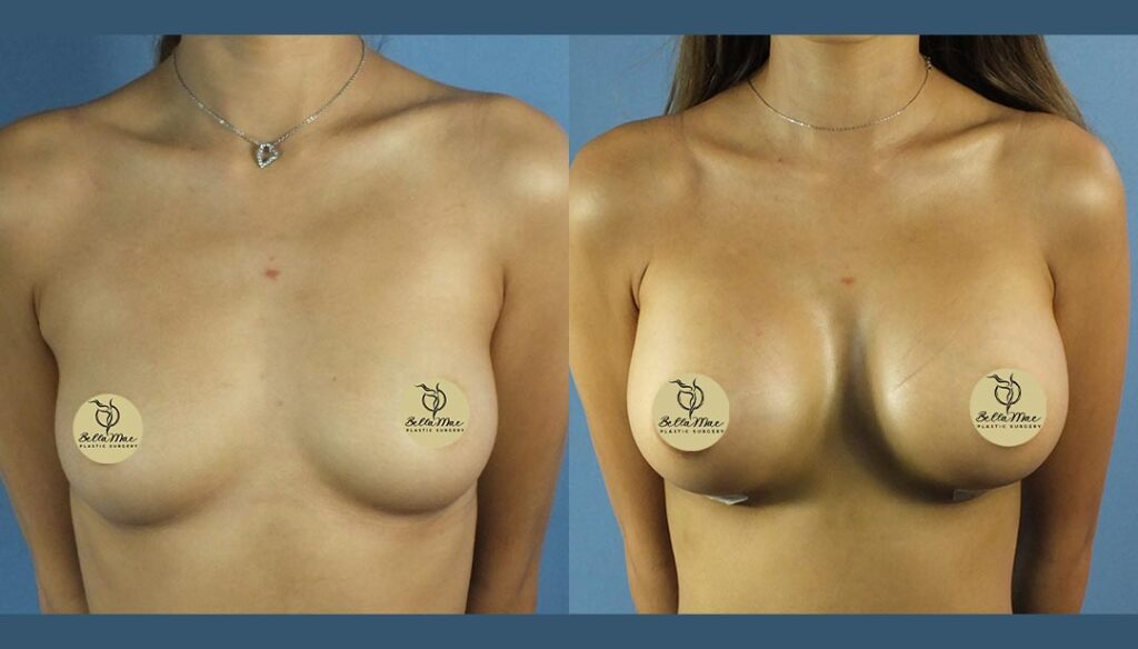 Breast Augmentation White Plains 04