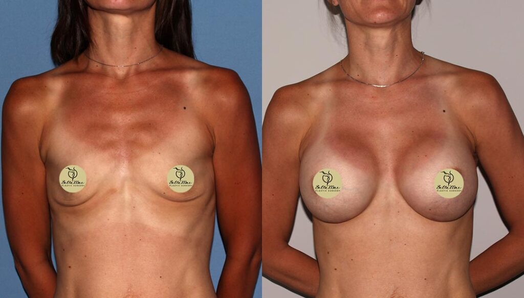 Breast Augmentation White Plains 05