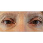 Blepharoplasty (Eyelid Surgery) Before & After Patient #441