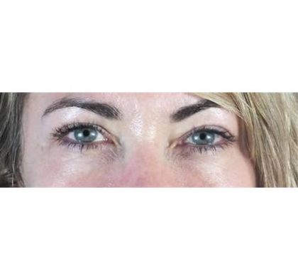 Blepharoplasty (Eyelid Surgery) Before & After Patient #438