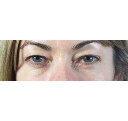 Blepharoplasty (Eyelid Surgery) Before & After Patient #438