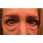 Blepharoplasty (Eyelid Surgery) Before & After Patient #435