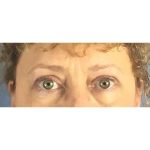 Blepharoplasty (Eyelid Surgery) Before & After Patient #432
