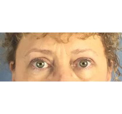 Blepharoplasty (Eyelid Surgery) Before & After Patient #432