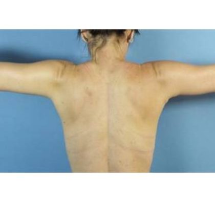Arm Lift Before & After Patient #423