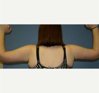 Arm Lift Before & After Patient #414