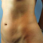 Liposuction Before & After Patient #239