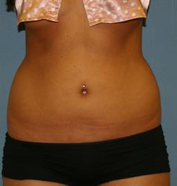 Liposuction Before & After Patient #242