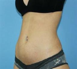 Liposuction Before & After Patient #245