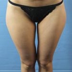 Liposuction Before & After Patient #248