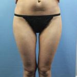 Liposuction Before & After Patient #248