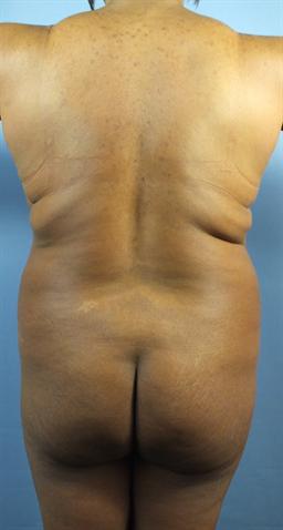 Liposuction Before & After Patient #251