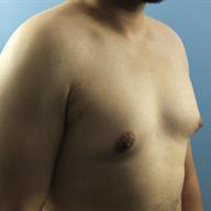 Gynecomastia Before & After Patient #233