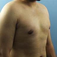 Gynecomastia Before & After Patient #233