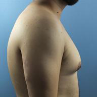 Gynecomastia Before & After Patient #236