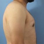 Gynecomastia Before & After Patient #236