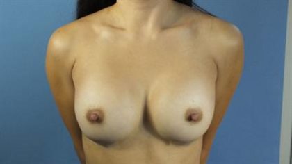 Breast Revision Before & After Patient #227