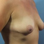 Breast Lift Before & After Patient #175