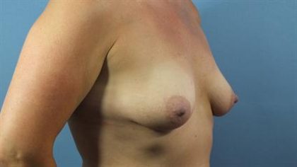 Breast Lift Before & After Patient #175