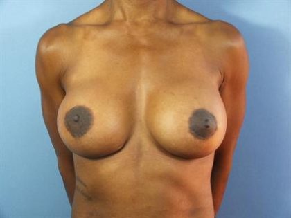 Breast Lift Before & After Patient #205
