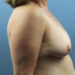 Breast Lift Before & After Patient #223