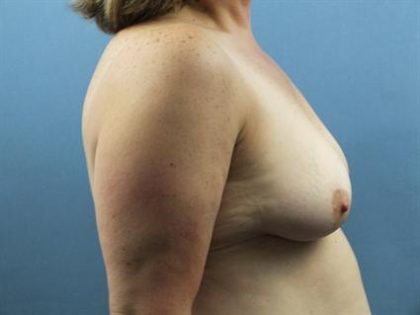 Breast Lift Before & After Patient #223