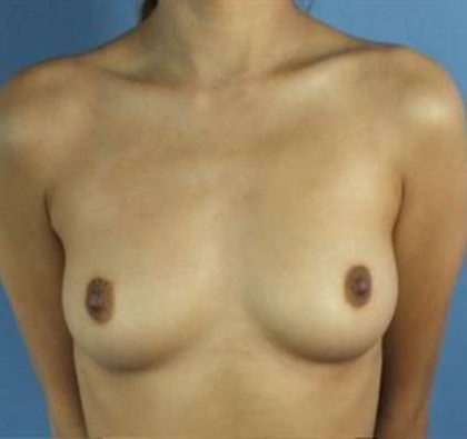 Breast Augmentation Before & After Patient #65