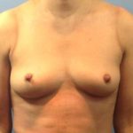 Breast Augmentation Before & After Patient #90