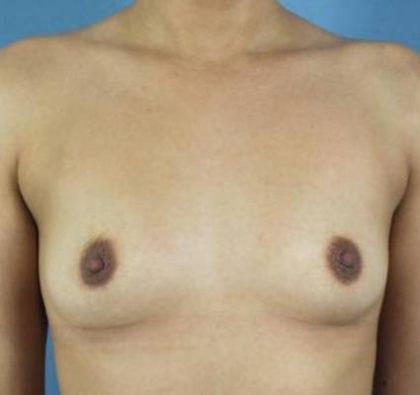 Breast Augmentation Before & After Patient #86