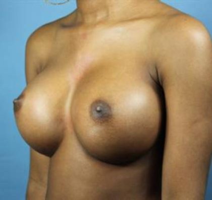 Breast Augmentation Before & After Patient #79