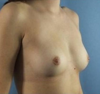 Breast Augmentation Before & After Patient #76