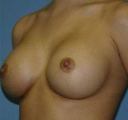 Breast Augmentation Before & After Patient #73