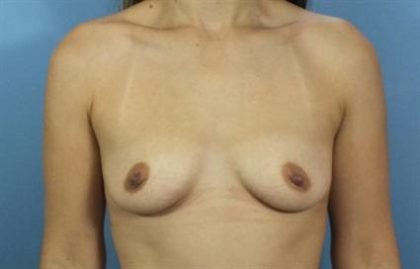 Breast Augmentation Before & After Patient #116