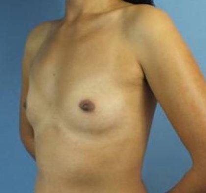 Breast Augmentation Before & After Patient #96