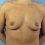 Breast Augmentation Before & After Patient #122
