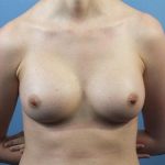 Breast Augmentation Before & After Patient #143