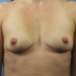 Breast Augmentation Before & After Patient #166