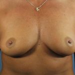 Breast Augmentation Before & After Patient #169