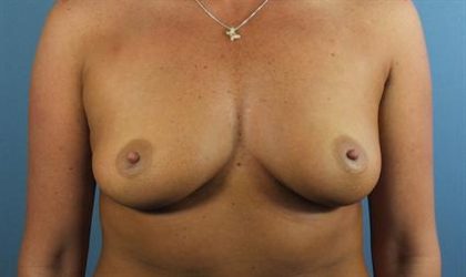 Breast Augmentation Before & After Patient #169