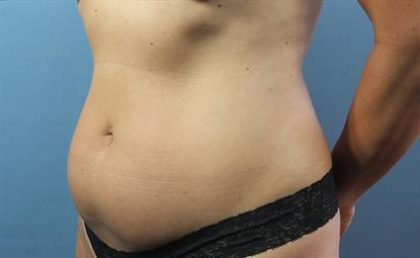 Liposuction Before & After Patient #257