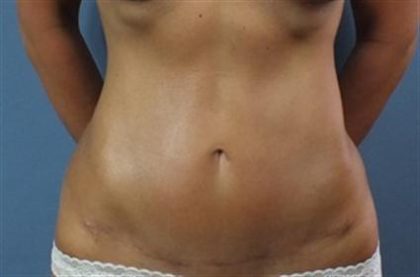 Liposuction Before & After Patient #257