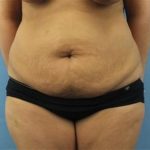 Tummy Tuck Before & After Patient #262