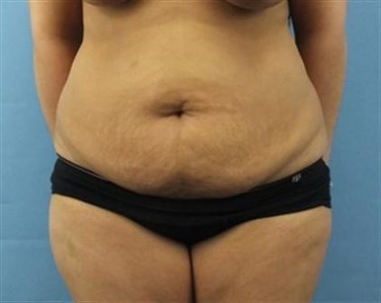 Tummy Tuck Before & After Patient #262